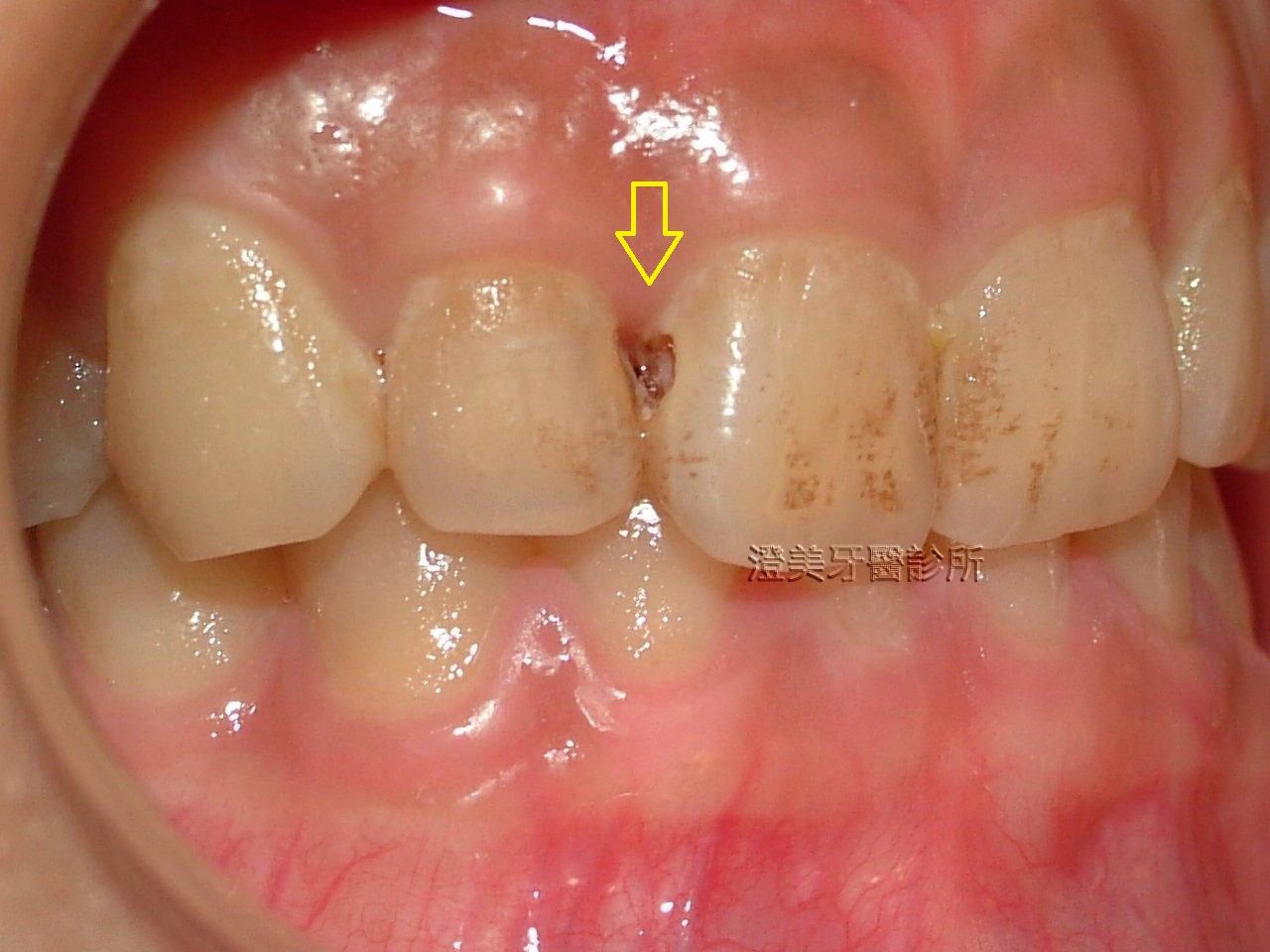 为什么说预防“六龄牙”龋齿很重要|龋齿|磨牙|窝沟龋_新浪新闻