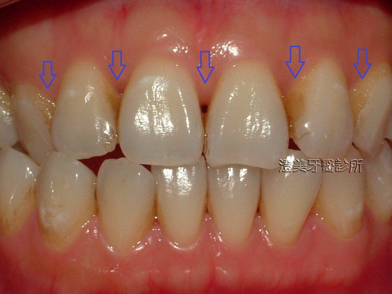 茶垢牙齒牙醫 - 牙齒分布圖